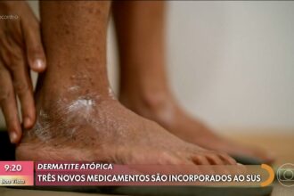 coceira,-inflamacao-e-machucados:-sus-passa-a-oferecer-novos-remedios-contra-dermatite-atopica