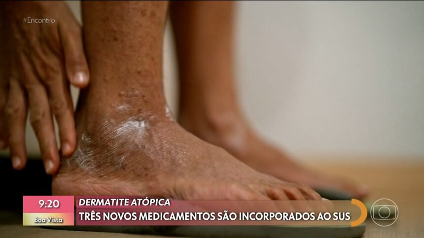coceira,-inflamacao-e-machucados:-sus-passa-a-oferecer-novos-remedios-contra-dermatite-atopica