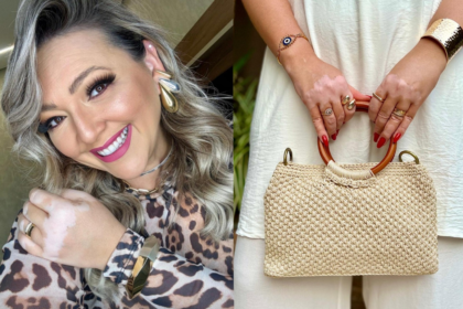 blogueira-com-vitiligo-ha-10-anos-transforma-vivencia-em-inspiracao:-‘nao-me-afeta-mais’