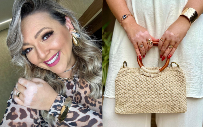 blogueira-com-vitiligo-ha-10-anos-transforma-vivencia-em-inspiracao:-‘nao-me-afeta-mais’
