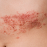 herpes-zoster:-conheca-causas,-sintomas-e-tratamento
