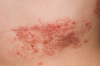 herpes-zoster:-conheca-causas,-sintomas-e-tratamento