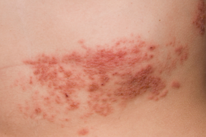 herpes-zoster:-conheca-causas,-sintomas-e-tratamento