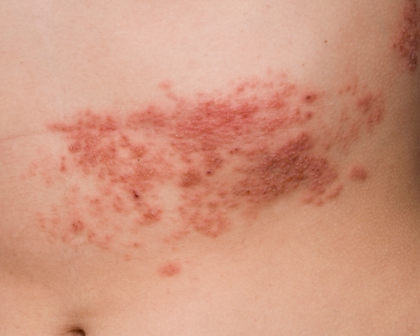 herpes-zoster:-conheca-causas,-sintomas-e-tratamento