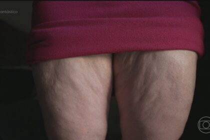 bem-estar-#306:-lipedema:-o-que-e-e-como-tratar