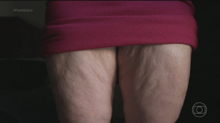 bem-estar-#306:-lipedema:-o-que-e-e-como-tratar
